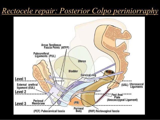 vaginal hysterectomy and bladder repair Vaginal hysterectomy and bladder repair